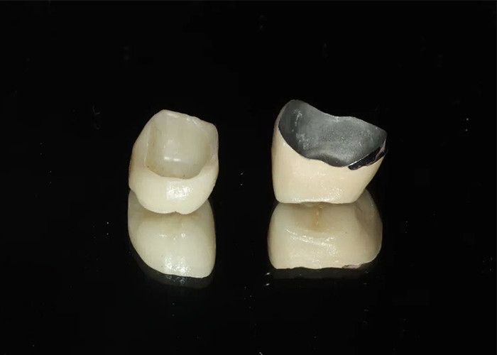 Porcellana di restauro altamente resistente fusa con corona metallica per un sorriso naturale