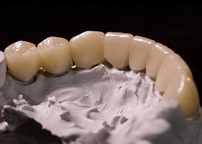 La porcellana fusa a corone metalliche: una tecnologia avanzata per il ristabilimento del sorriso duraturo