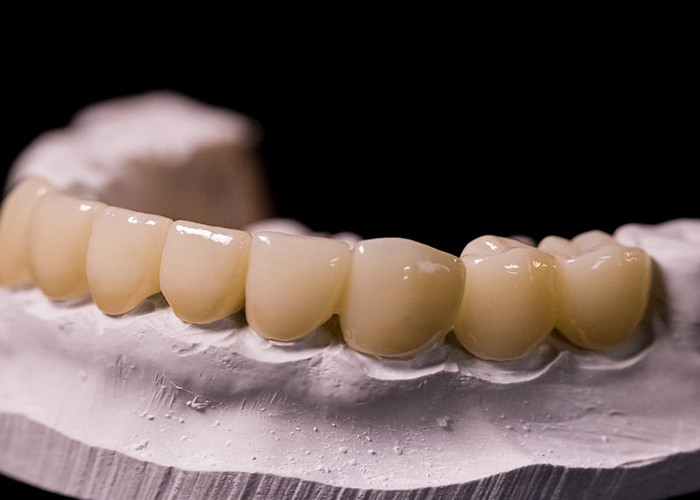 La porcellana fusa a corone metalliche: una tecnologia avanzata per il ristabilimento del sorriso duraturo