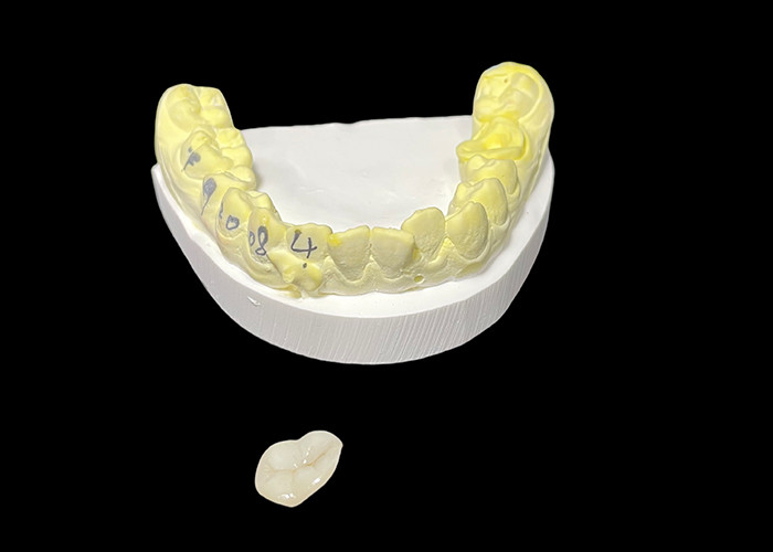 Infissi e infissi di ceramica dentaria su misura per soluzioni riparative e riparazione di denti danneggiati