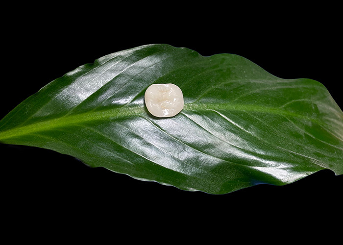 Infissi e infissi di ceramica dentaria su misura per soluzioni riparative e riparazione di denti danneggiati