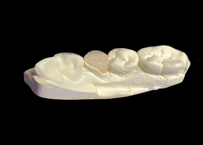 Infissi e infissi di ceramica dentaria su misura per soluzioni riparative e riparazione di denti danneggiati