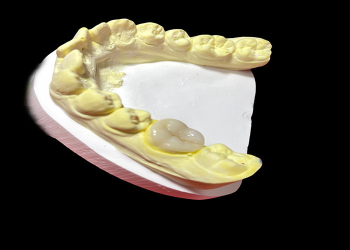 Infissi e infissi in ceramica di alta qualità per la restauro dei denti senza saldature e a lunga durata