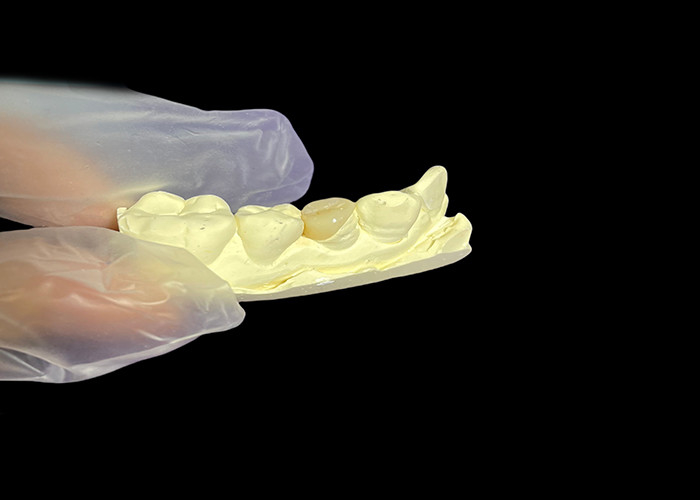 Inlay dentale in ceramica Onlay per la riparazione efficace dei denti con soluzioni di porcellana durevoli ed estetiche per il restauro duraturo