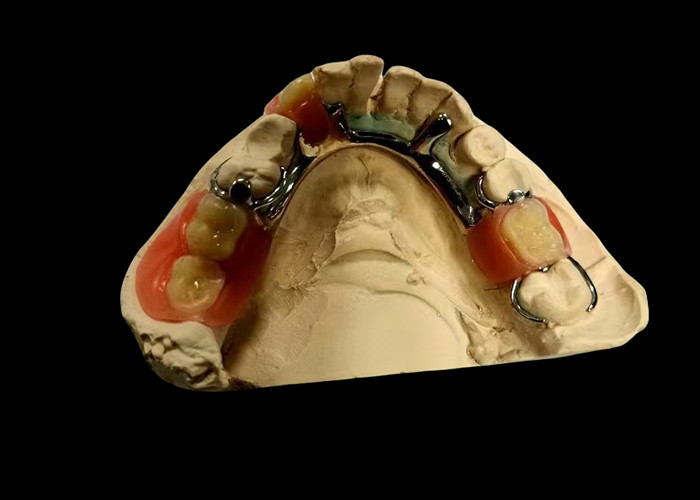 Denti rimovibili parziali a base metallica e resina acrilica per un'aspetto sicuro e naturale