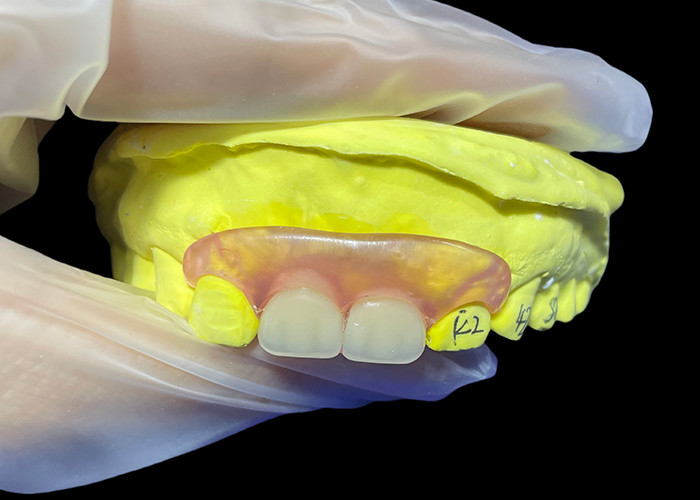 Sostituzione della protesi paritale flessibile per masticare e parlare comodamente