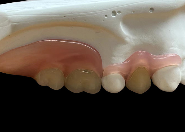Protesi flessibile invisibile regolabile: sicura per masticare e parlare comodamente con durabilità variabile