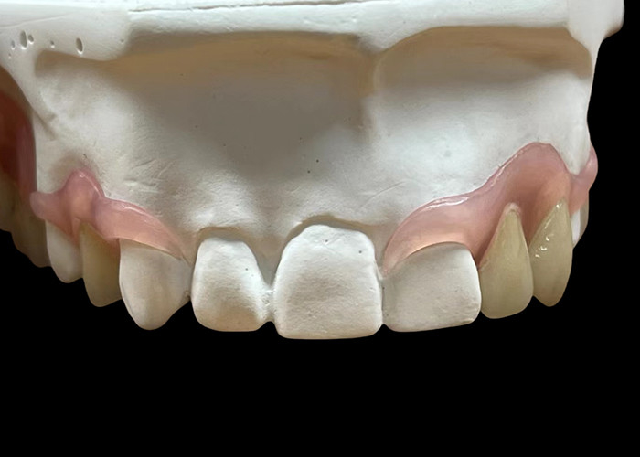 Sostituzione della protesi paritale flessibile per masticare e parlare comodamente