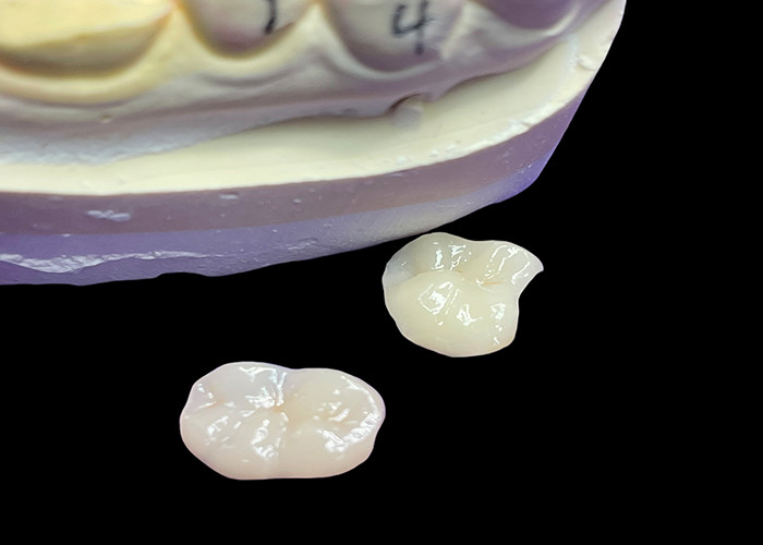IPS e.max Infissi e infissi in ceramica per il restauro molare Estetica naturale e durata superiore per risultati duraturi