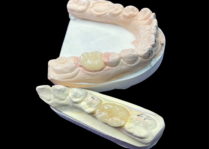 IPS e.max Infissi e infissi in ceramica per il restauro molare Estetica naturale e durata superiore per risultati duraturi