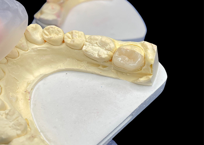 IPS e.max Infissi e infissi in ceramica per il restauro molare Estetica naturale e durata superiore per risultati duraturi