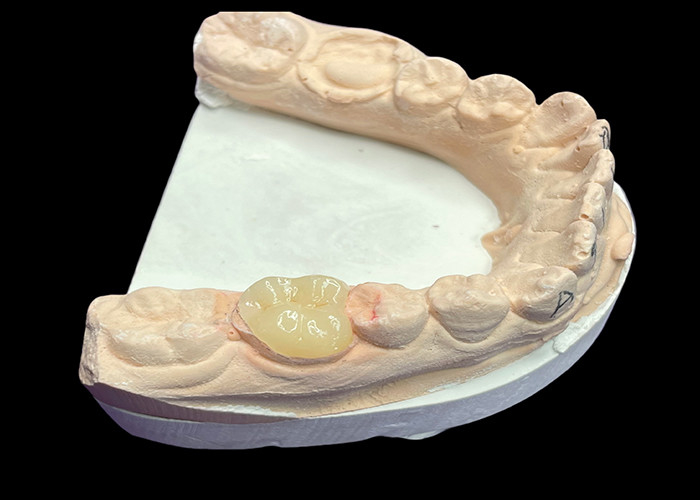 Intaglio di ceramica dentale liscia su misura per la riparazione dei denti senza cuciture resistenti alle macchie e estetica naturale