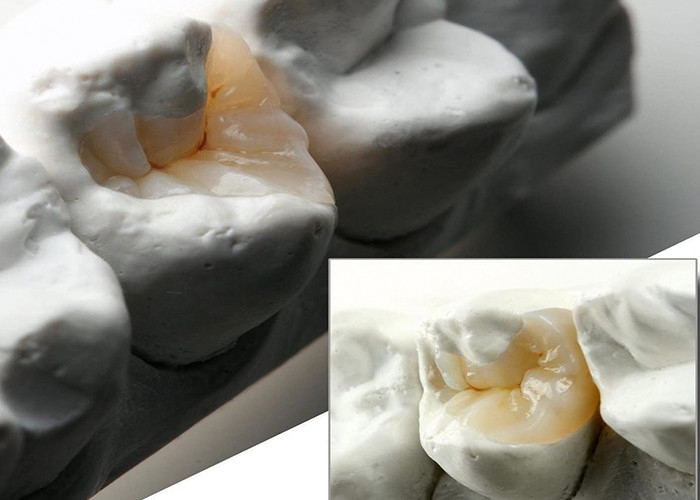 Infissi ceramici naturali e infissi per la restaurazione dentale precisa dal nostro laboratorio odontoiatrico esperto