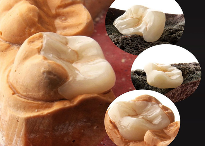Infissi ceramici naturali e infissi per la restaurazione dentale precisa dal nostro laboratorio odontoiatrico esperto