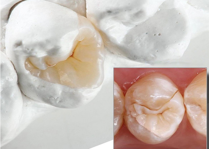 Infissi ceramici naturali e infissi per la restaurazione dentale precisa dal nostro laboratorio odontoiatrico esperto