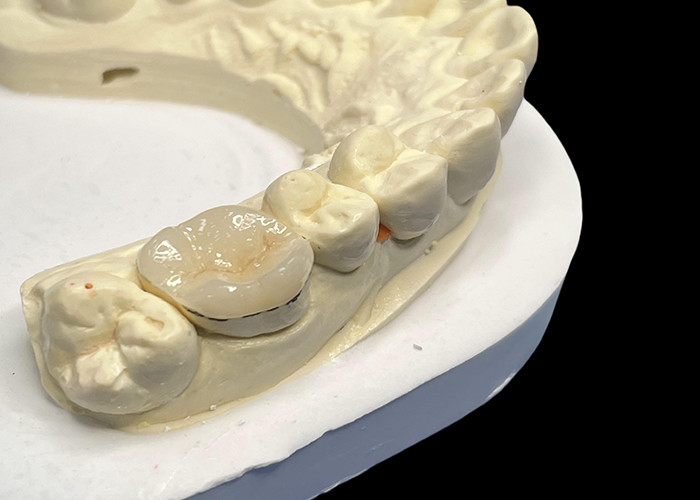 Infissi di porcellana ipoallergenici Infissi per la riparazione dei denti Colore naturale e facile manutenzione