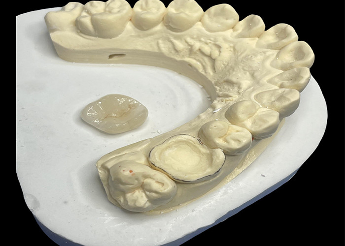 Inlay dentale in ceramica Onlay per la riparazione efficace dei denti con soluzioni di porcellana durevoli ed estetiche per il restauro duraturo