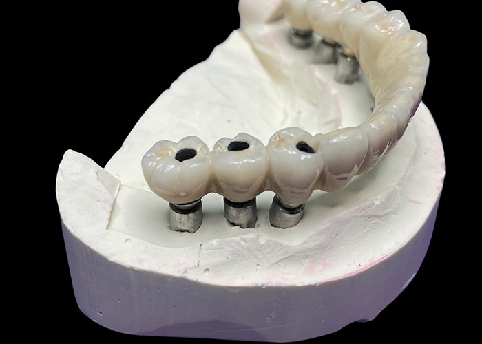 L'impianto dentale con una base in titanio è coperto da un bellissimo ponte di corona in ceramica per creare una restaurazione perfetta.