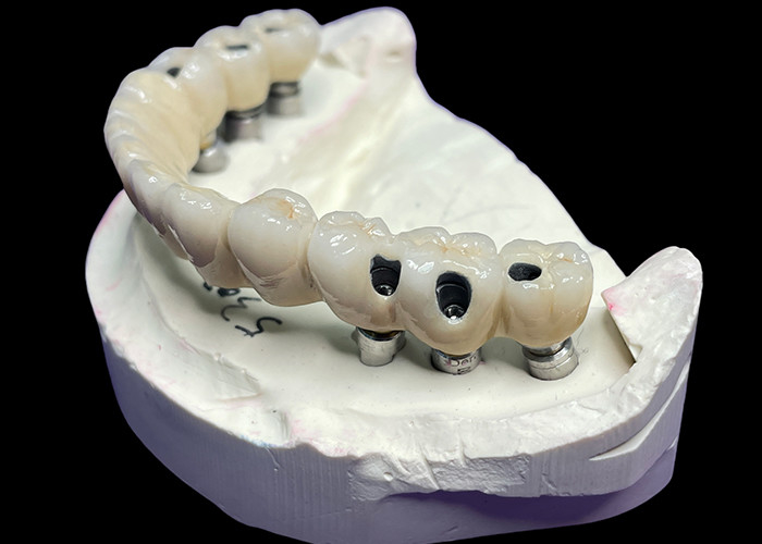 Corone e ponti di impianto dentale a arco completo che ripristinano la funzione e l'estetica con soluzioni avanzate