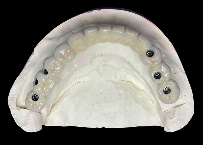 L'impianto dentale con una base in titanio è coperto da un bellissimo ponte di corona in ceramica per creare una restaurazione perfetta.