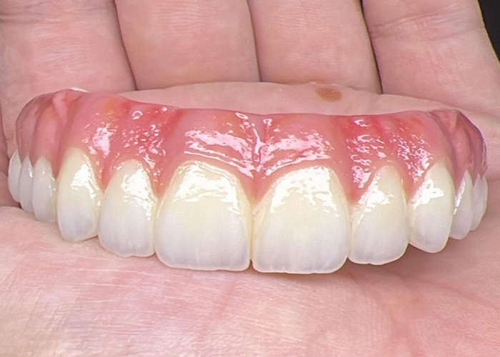 Salubrità orale Impianto dentale Protesi protesi a supporto Superficie lucidata ponte Protesi a supporto protesi complete