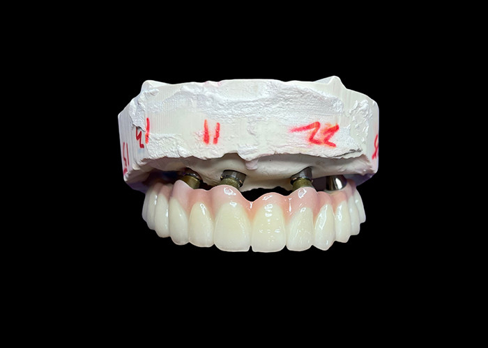 Impianti dentali con protesi a arco completo fisse per una soluzione permanente, stabile e naturale ai denti mancanti