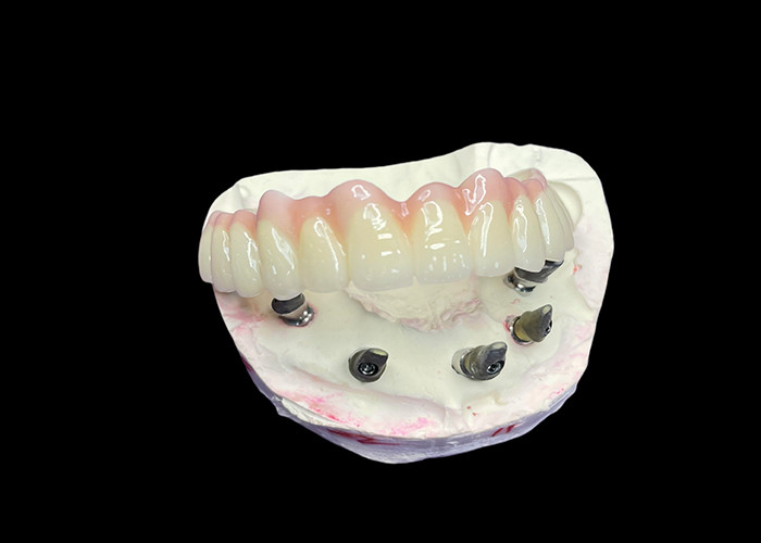 Impianti dentali con protesi a arco completo fisse per una soluzione permanente, stabile e naturale ai denti mancanti