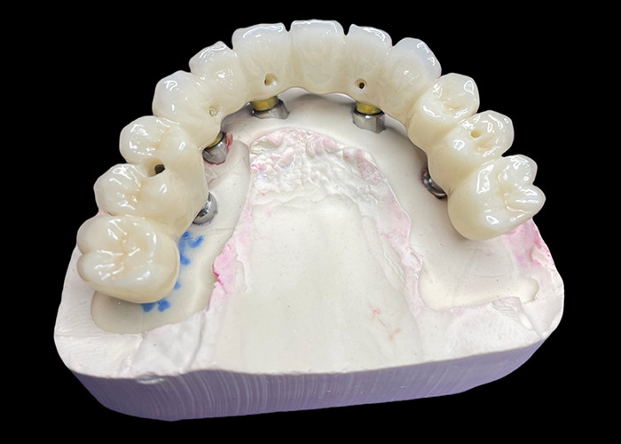 Corone e ponti di impianto dentale a arco completo che ripristinano la funzione e l'estetica con soluzioni avanzate