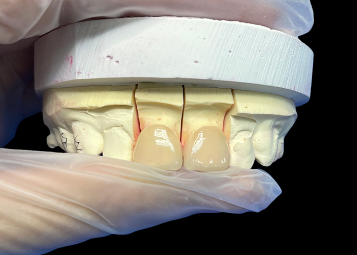 Precisione di resistenza EMAX incisivo in finitura di porcellana per restauri estetici dall'aspetto naturale