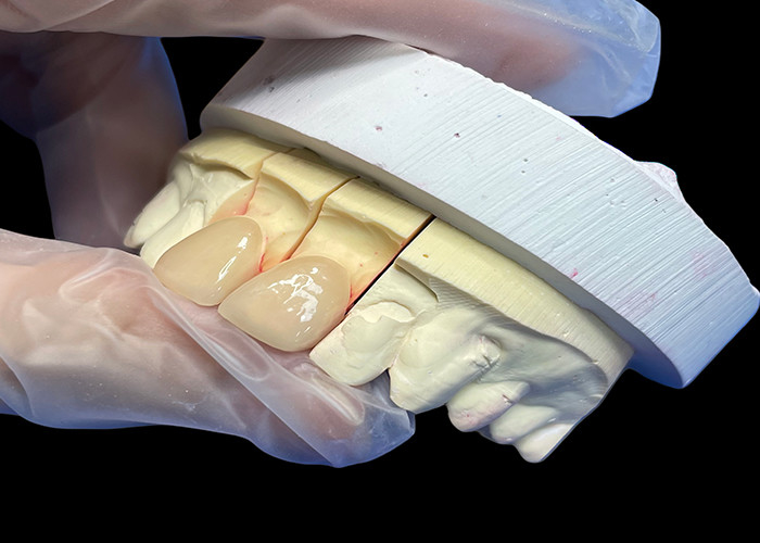 Precisione di resistenza EMAX incisivo in finitura di porcellana per restauri estetici dall'aspetto naturale