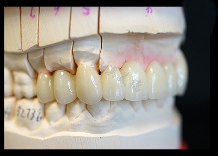 Forza Estetica naturale Corona di zirconia solida Perfetta per denti singoli o multipli
