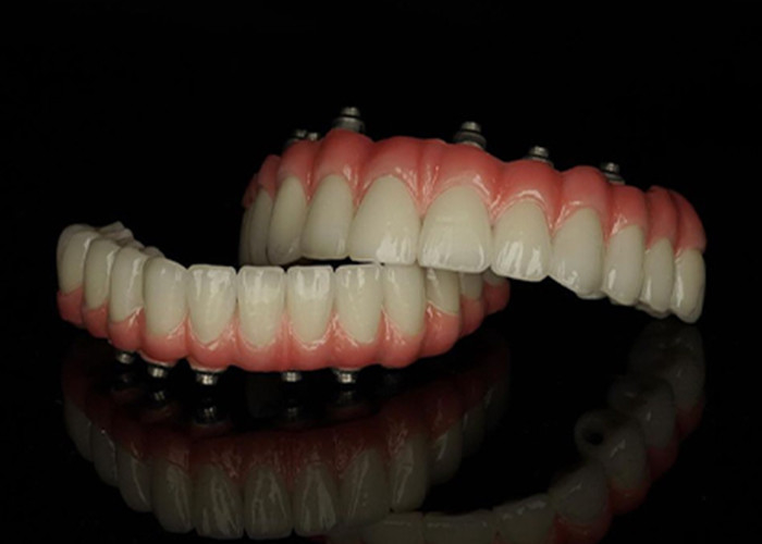 Protesi a base di titanio con impianto fisso con ponte di corona in ceramica per sostituire i denti mancanti