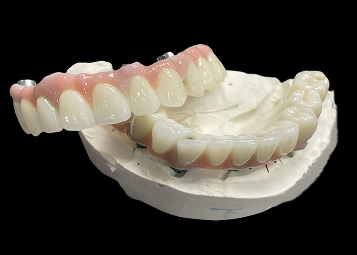 Protesi a base di titanio con impianto fisso con ponte di corona in ceramica per sostituire i denti mancanti