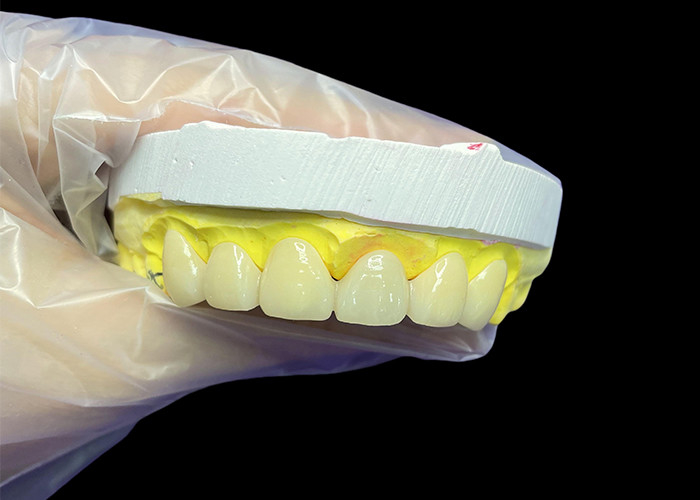 Cosmetico Vita Sfumatura classica Corone e ponti in ceramica con aspetto naturale e opzioni personalizzabili