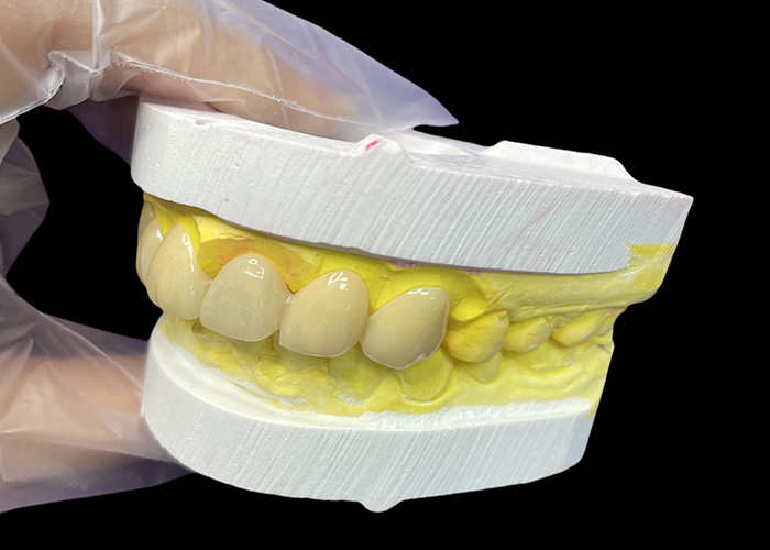 Cosmetico Vita Sfumatura classica Corone e ponti in ceramica con aspetto naturale e opzioni personalizzabili