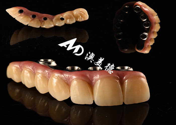 Impianto dentale naturale ponte corona fissato con pilastro di titanio per la chirurgia dei denti mancanti