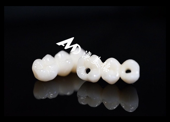 Impianto dentale naturale ponte corona fissato con pilastro di titanio per la chirurgia dei denti mancanti