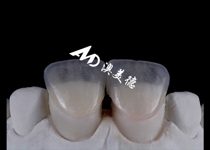 Trasforma il tuo sorriso con IPS emax Pressa Vene di porcellana Forza Estetica e durata combinate