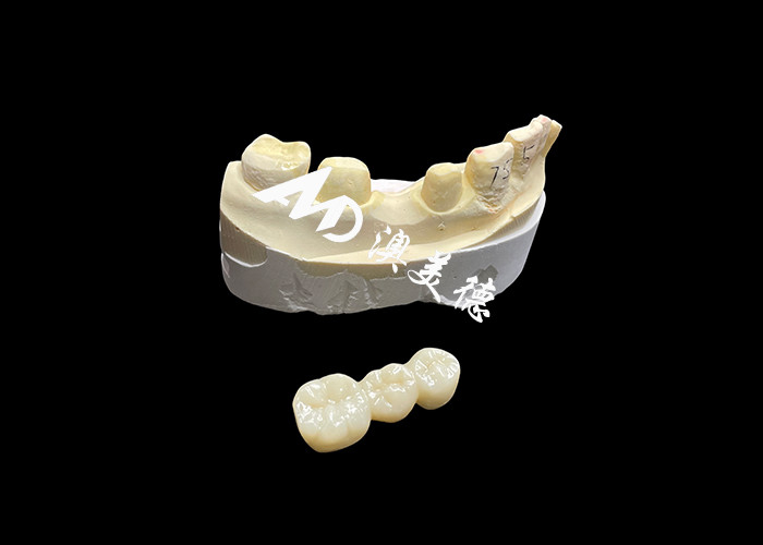 Corona dentale in zirconia estetica ad alta durezza con traslucidità e resistenza ai frantumi dal laboratorio dentale cinese