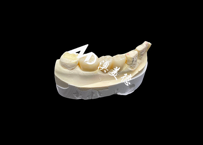 Corona dentale in zirconia estetica ad alta durezza con traslucidità e resistenza ai frantumi dal laboratorio dentale cinese