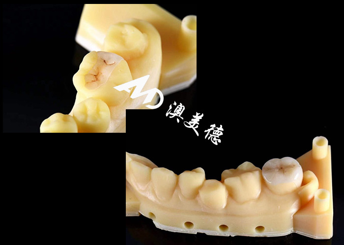 Infissi e infissi in ceramica di precisione per la riparazione dei denti con colore naturale Materiale ipoallergenico e adatta senza cuciture per un comfort e una durata superiori