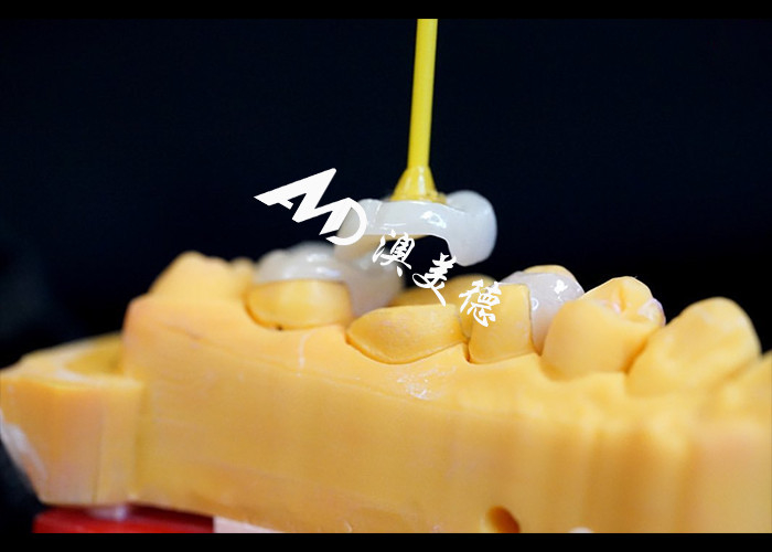 Infissi e infissi in ceramica di precisione per la riparazione dei denti con colore naturale Materiale ipoallergenico e adatta senza cuciture per un comfort e una durata superiori