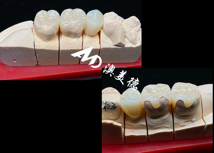 OEM Precision Fit Inlays in ceramica Onlays per restauri dentali durevoli e dall'aspetto naturale con resistenza e affidabilità superiori