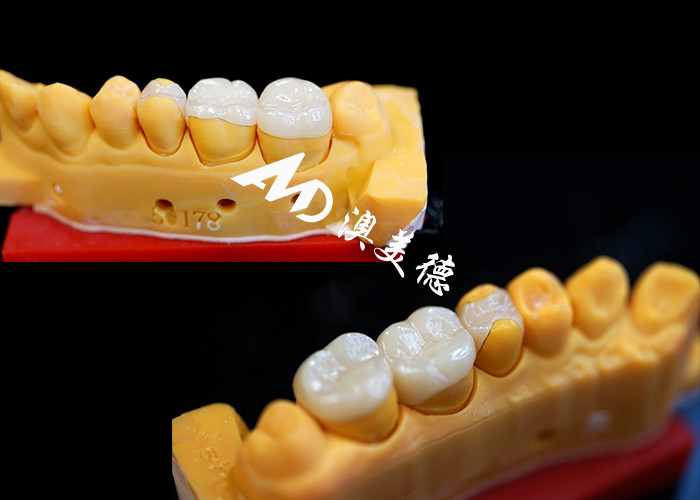 OEM Precision Fit Inlays in ceramica Onlays per restauri dentali durevoli e dall'aspetto naturale con resistenza e affidabilità superiori