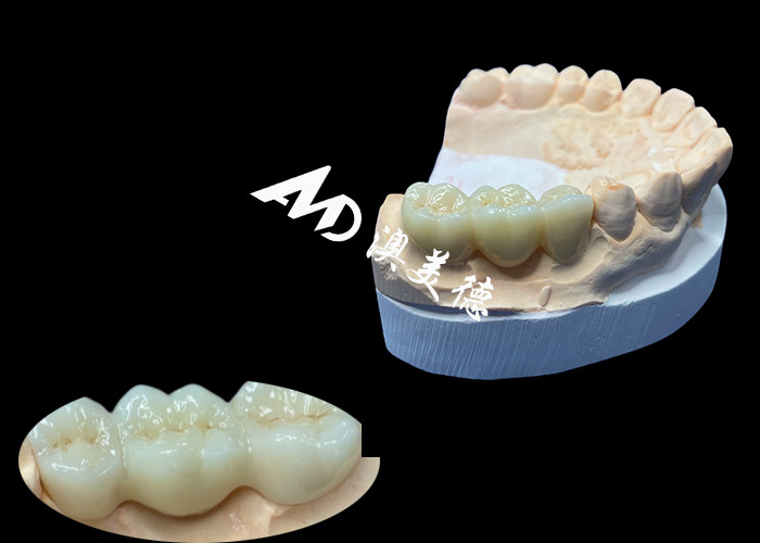 Corone dentale di zirconia di colore naturale resistente alle crepe per un sorriso impeccabile dal laboratorio dentale cinese