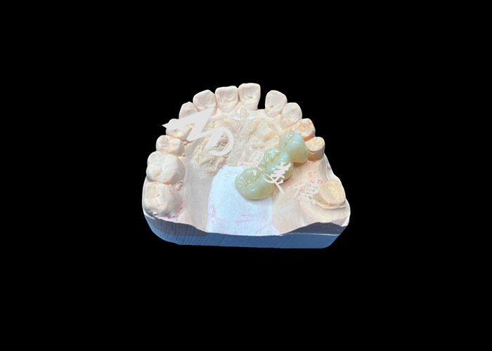 Corone dentale di zirconia di colore naturale resistente alle crepe per un sorriso impeccabile dal laboratorio dentale cinese