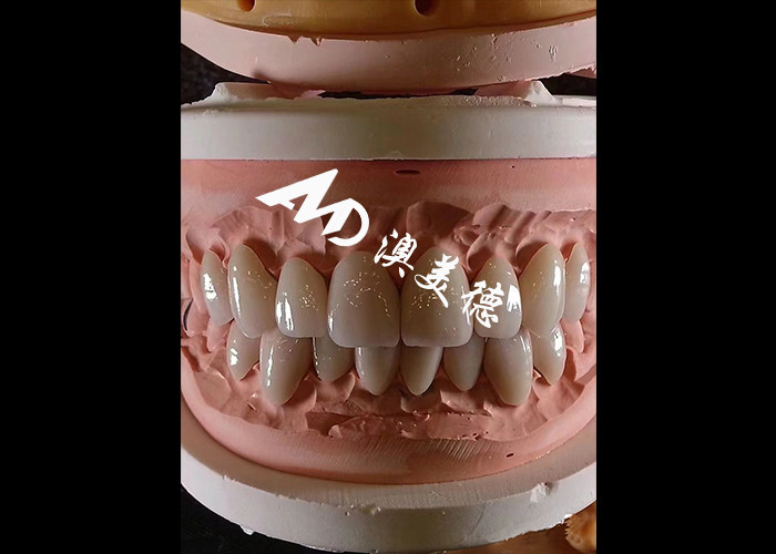 Dentistica cosmetica EMAX Finiture dentali di spessore 0,3-0,5 mm per restauri estetici