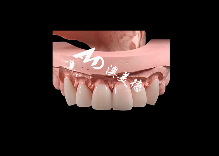 Dentistica cosmetica EMAX Finiture dentali di spessore 0,3-0,5 mm per restauri estetici