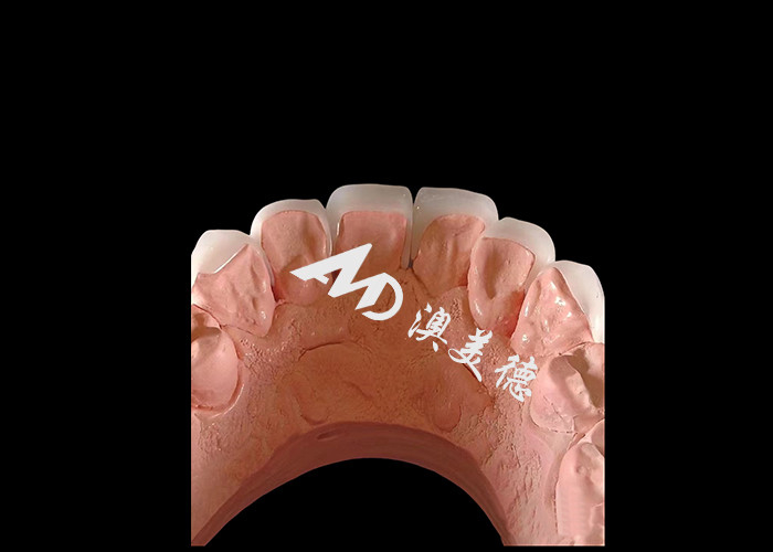 Dentistica cosmetica EMAX Finiture dentali di spessore 0,3-0,5 mm per restauri estetici