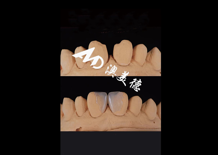 0.3-0.5mm Ultra sottile IPS EMAX Porcellane Veneers per il Makeover del sorriso estetico